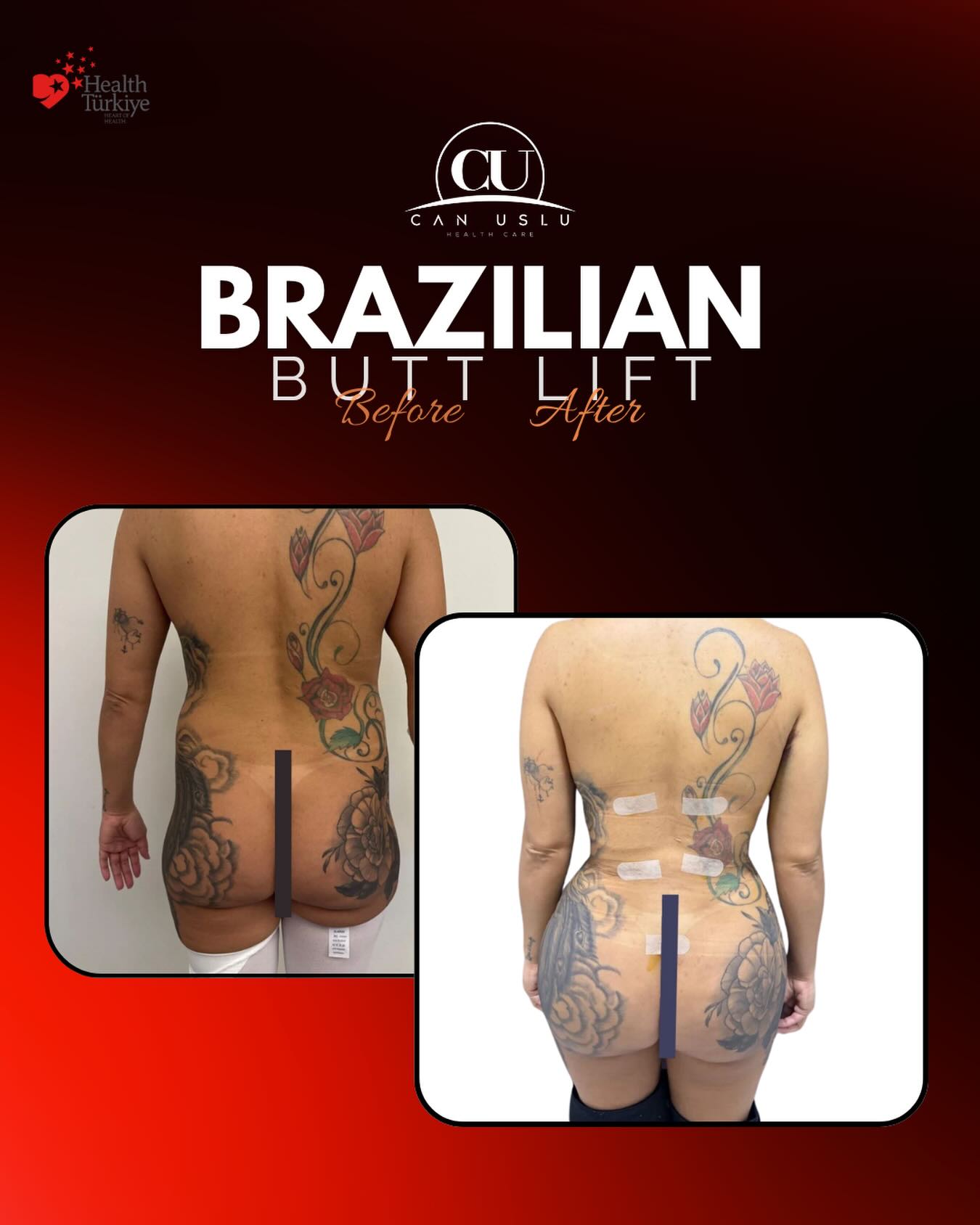Brazilian Butt Lift öncesi sonrası