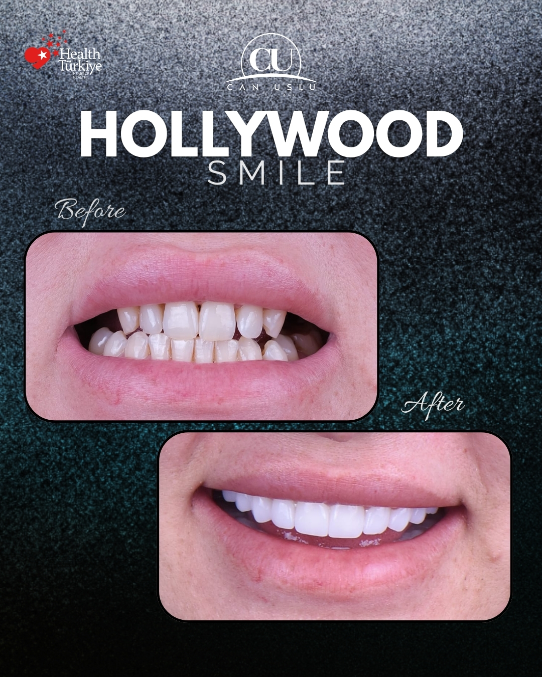 Hollywood Smile öncesi sonrası