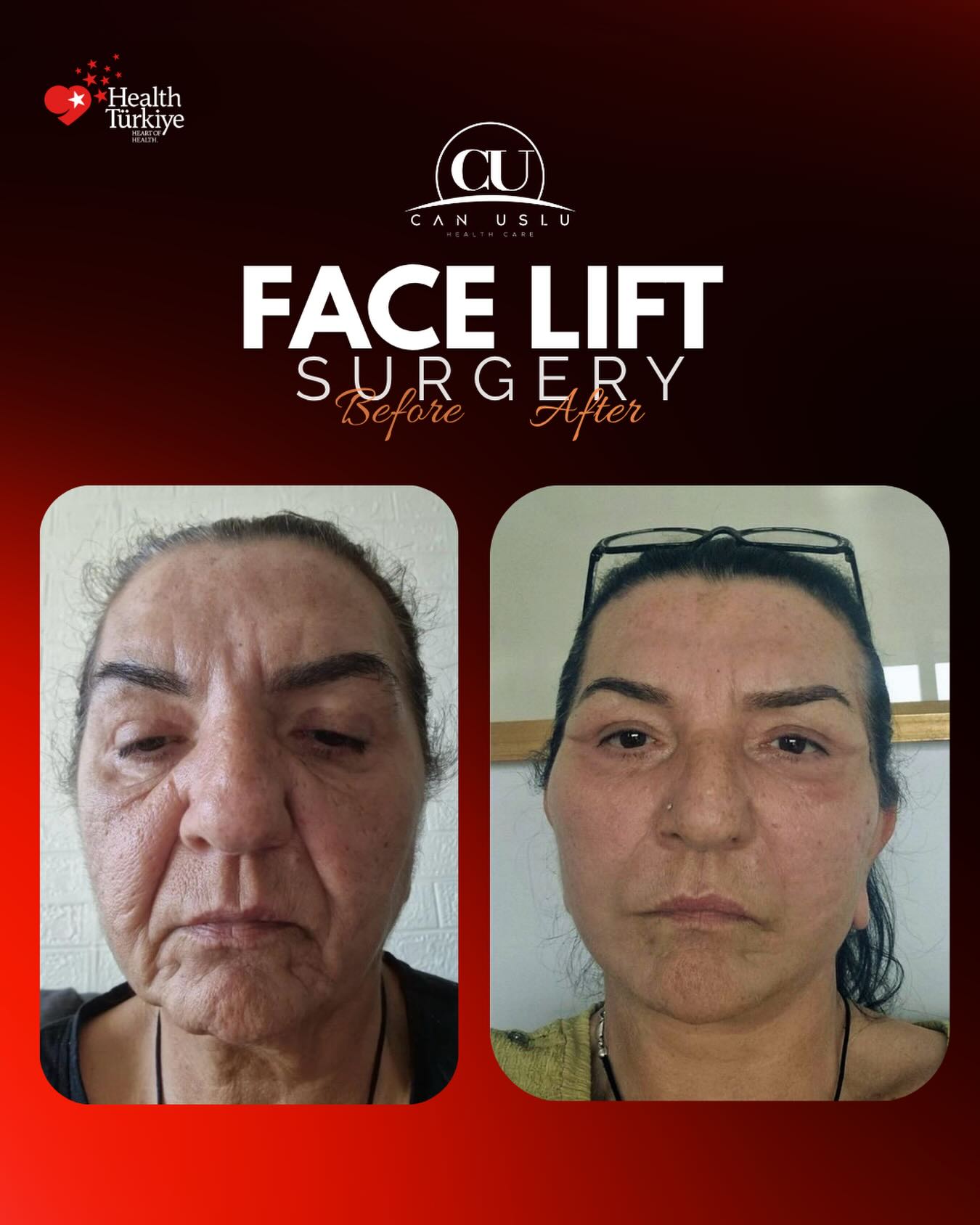 Deep Plane Facelift öncesi sonrası
