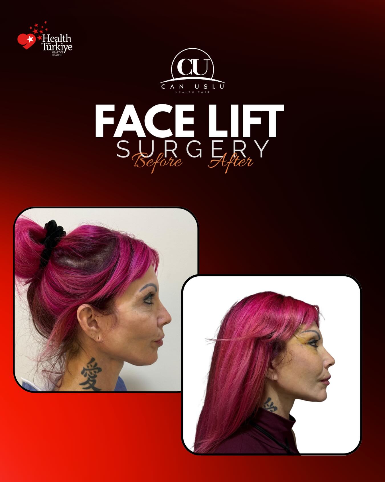 Deep Plane Facelift öncesi sonrası