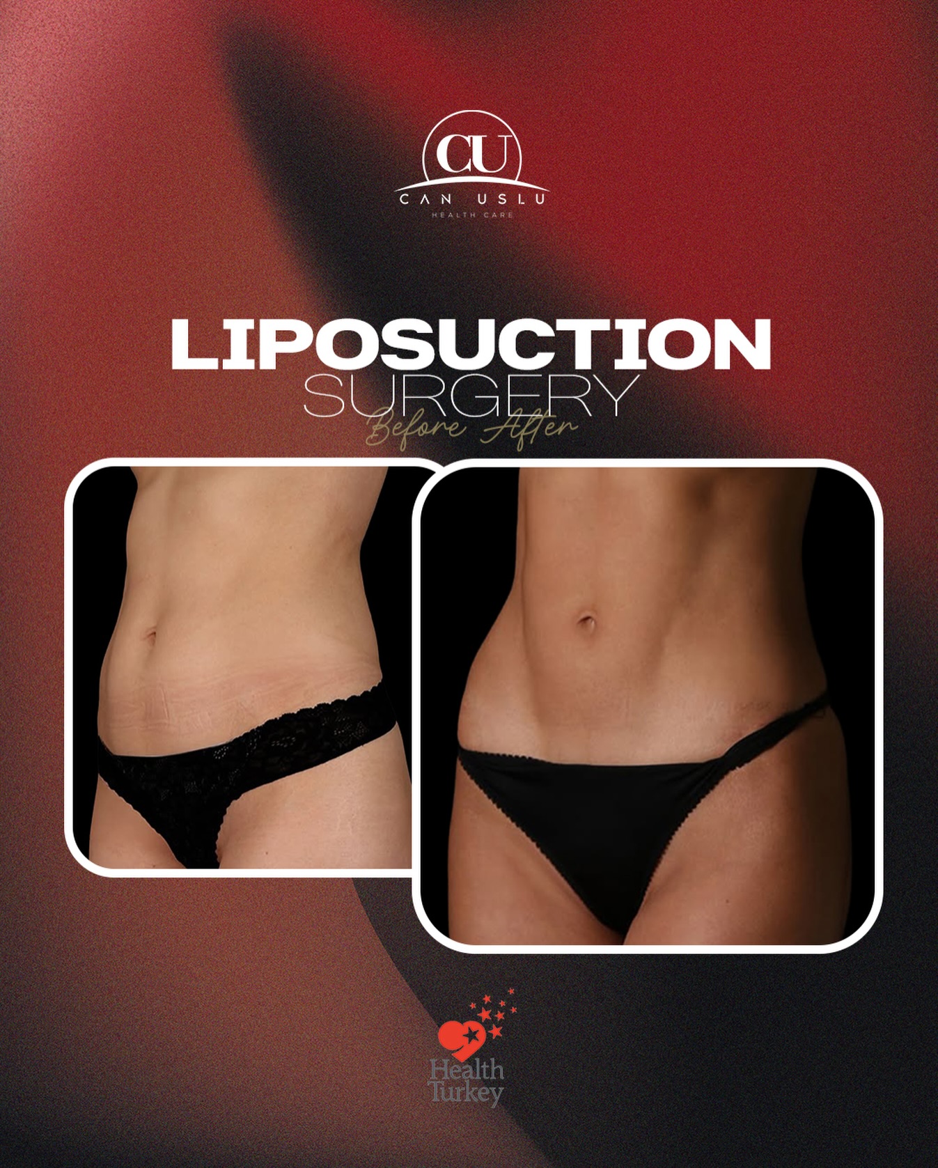 Liposuction 360 öncesi sonrası