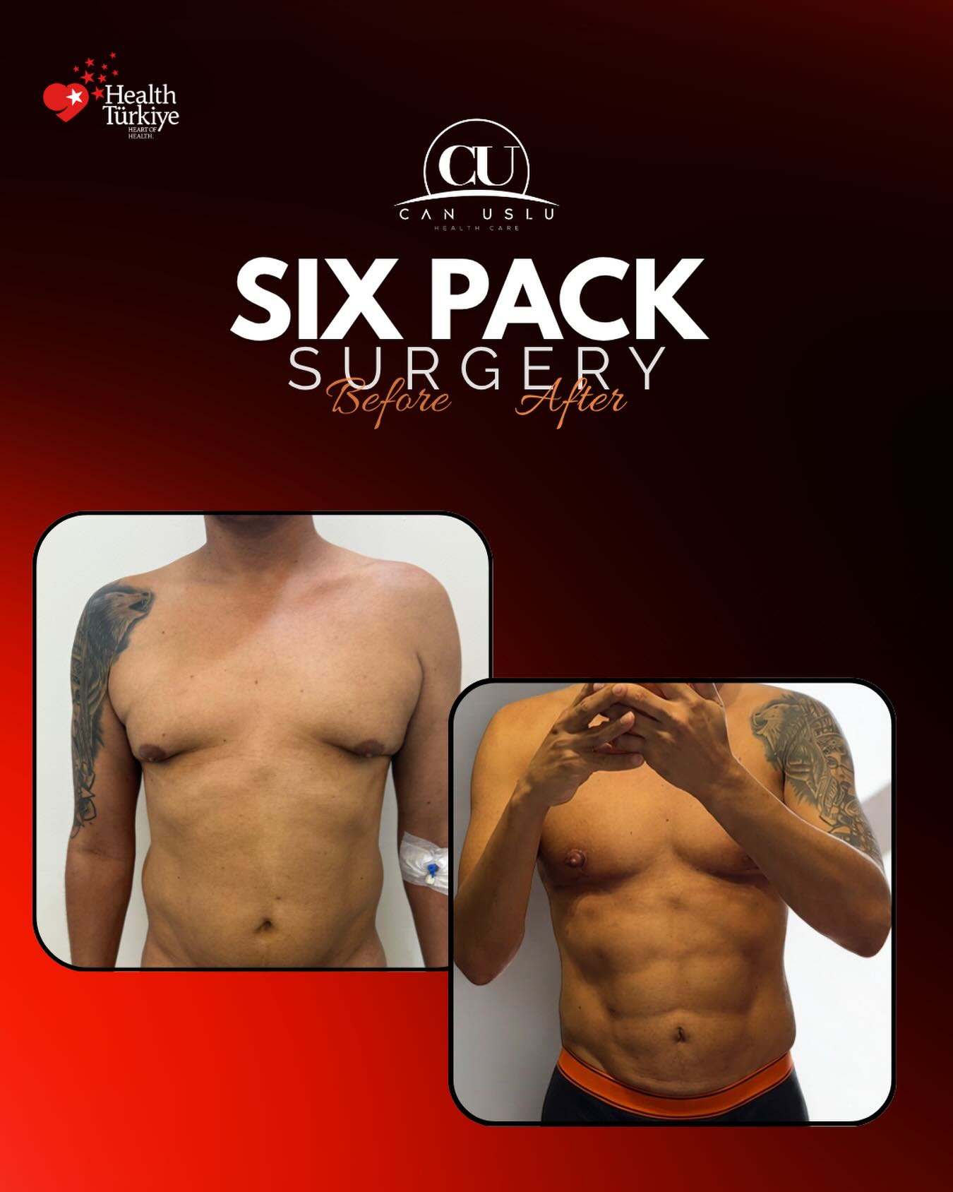 Liposuction · Sixpack öncesi sonrası