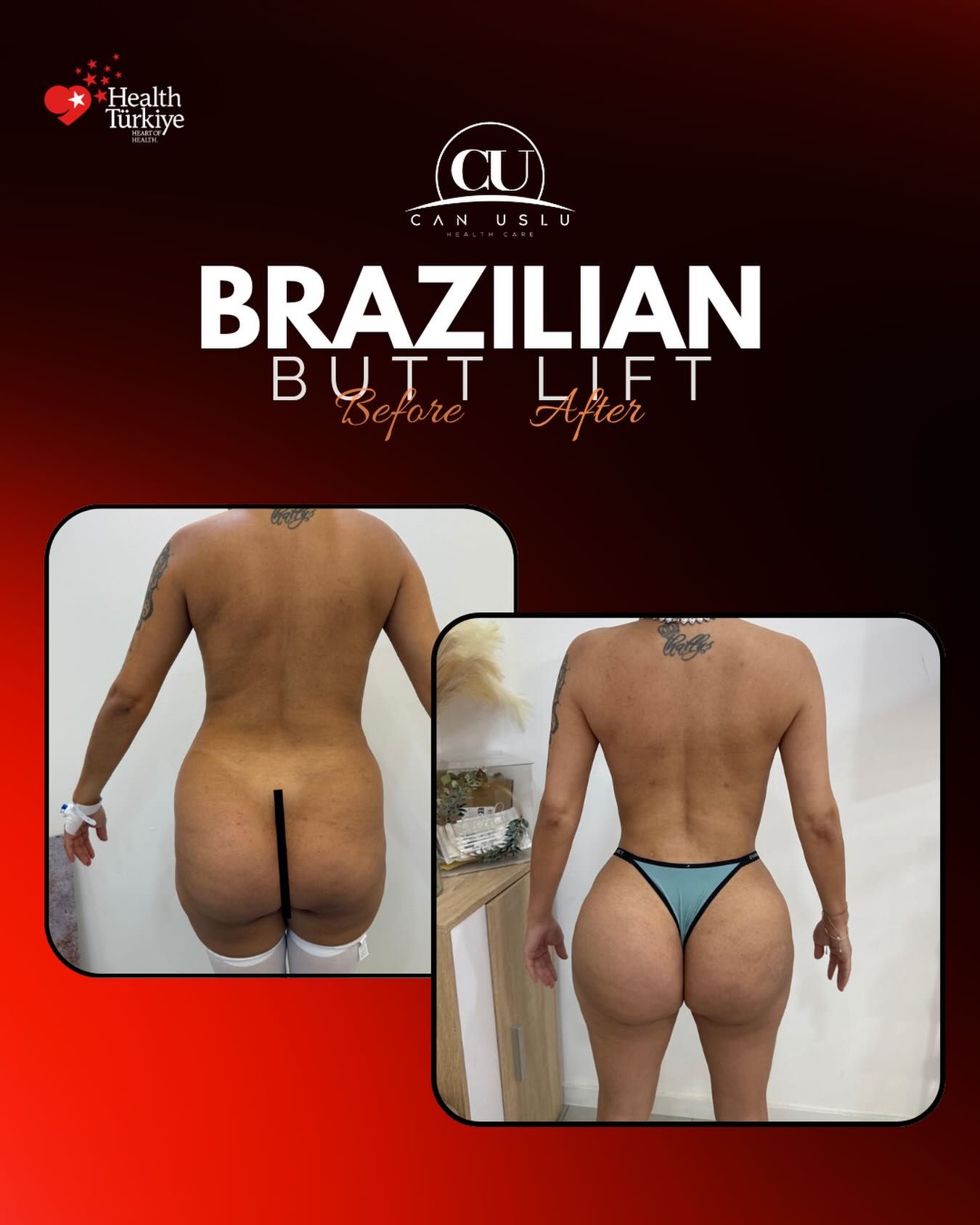 Brazilian Butt Lift before/after