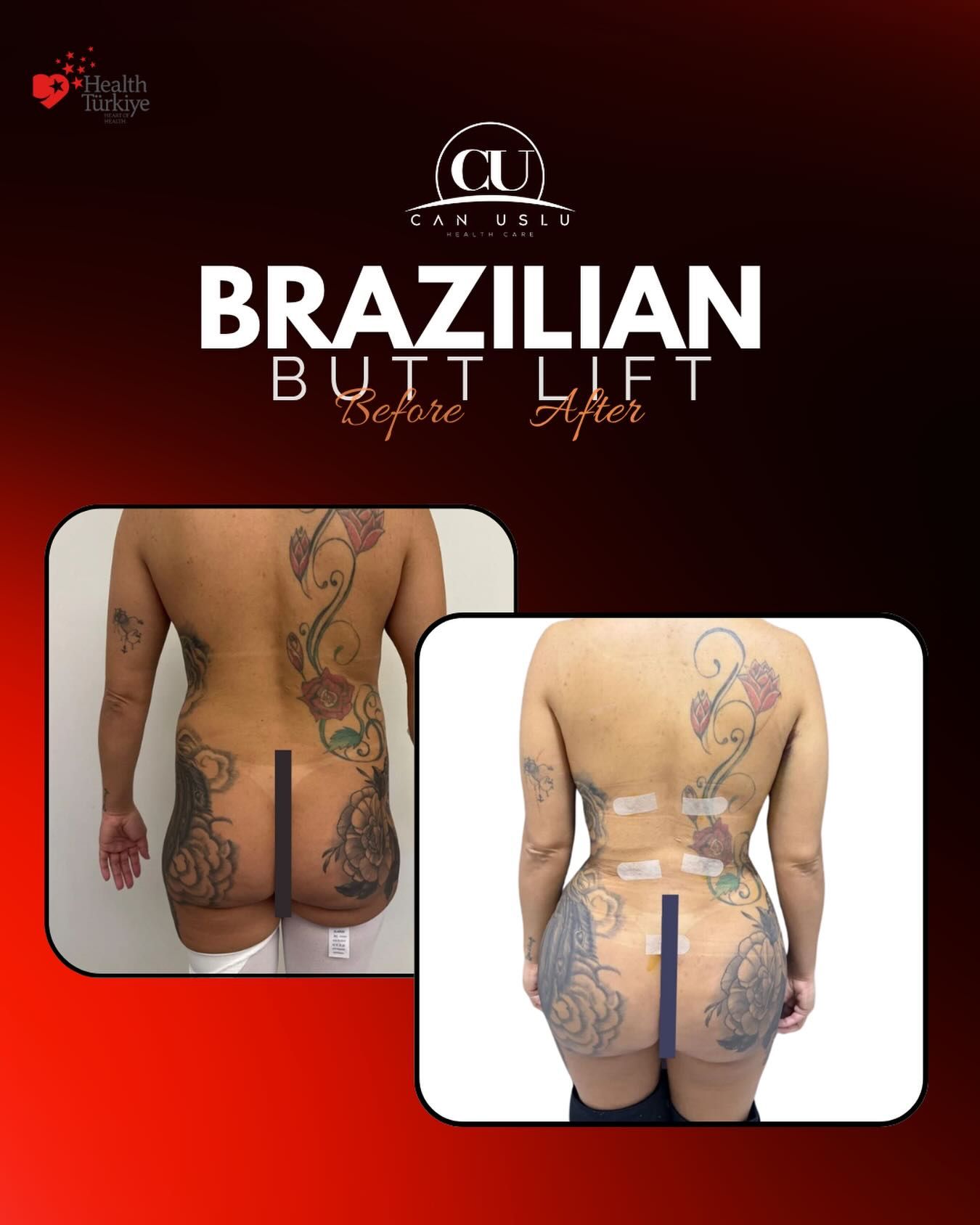 Brazilian Butt Lift before/after