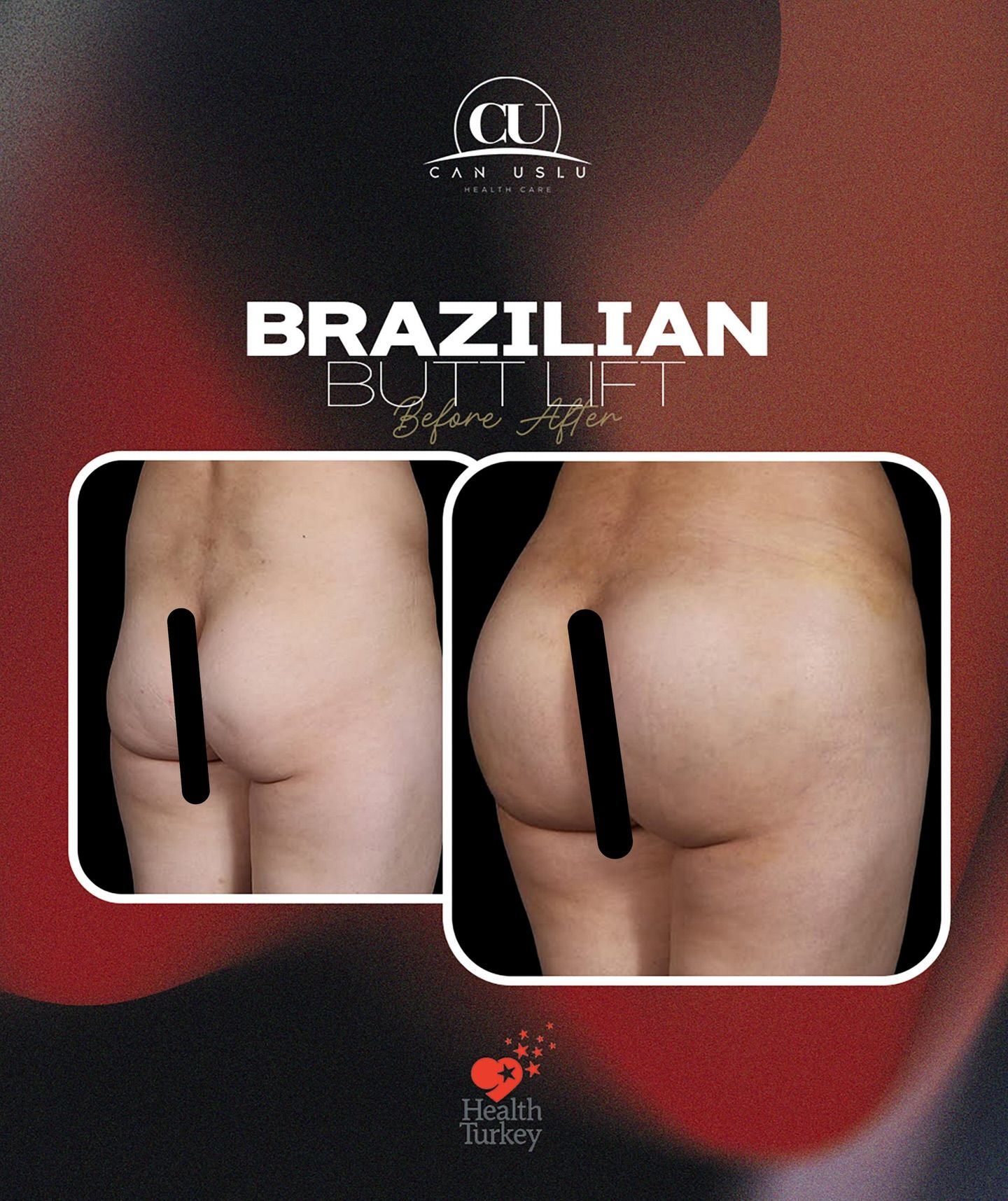 Brazilian Butt Lift before/after