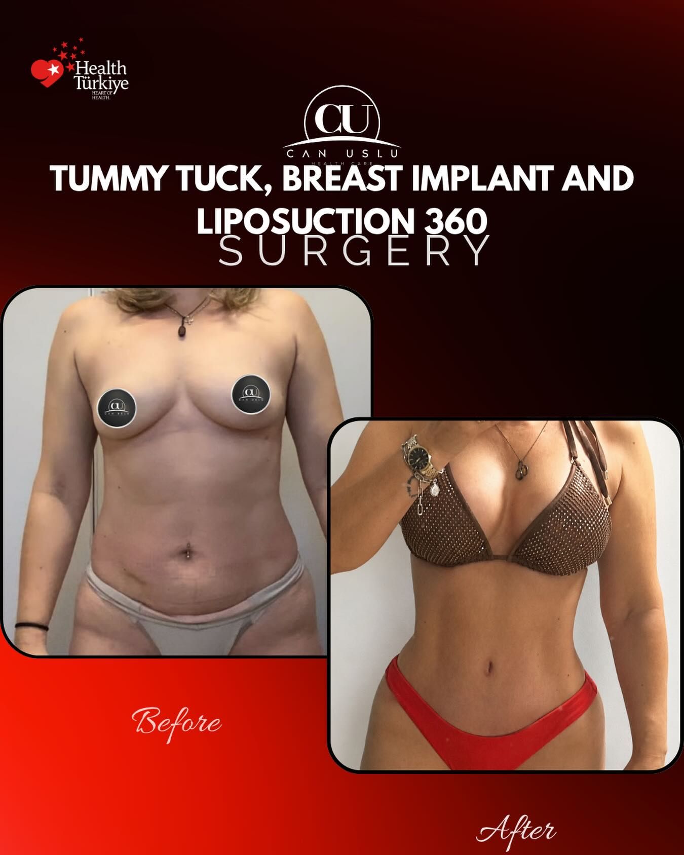 Liposuction before/after