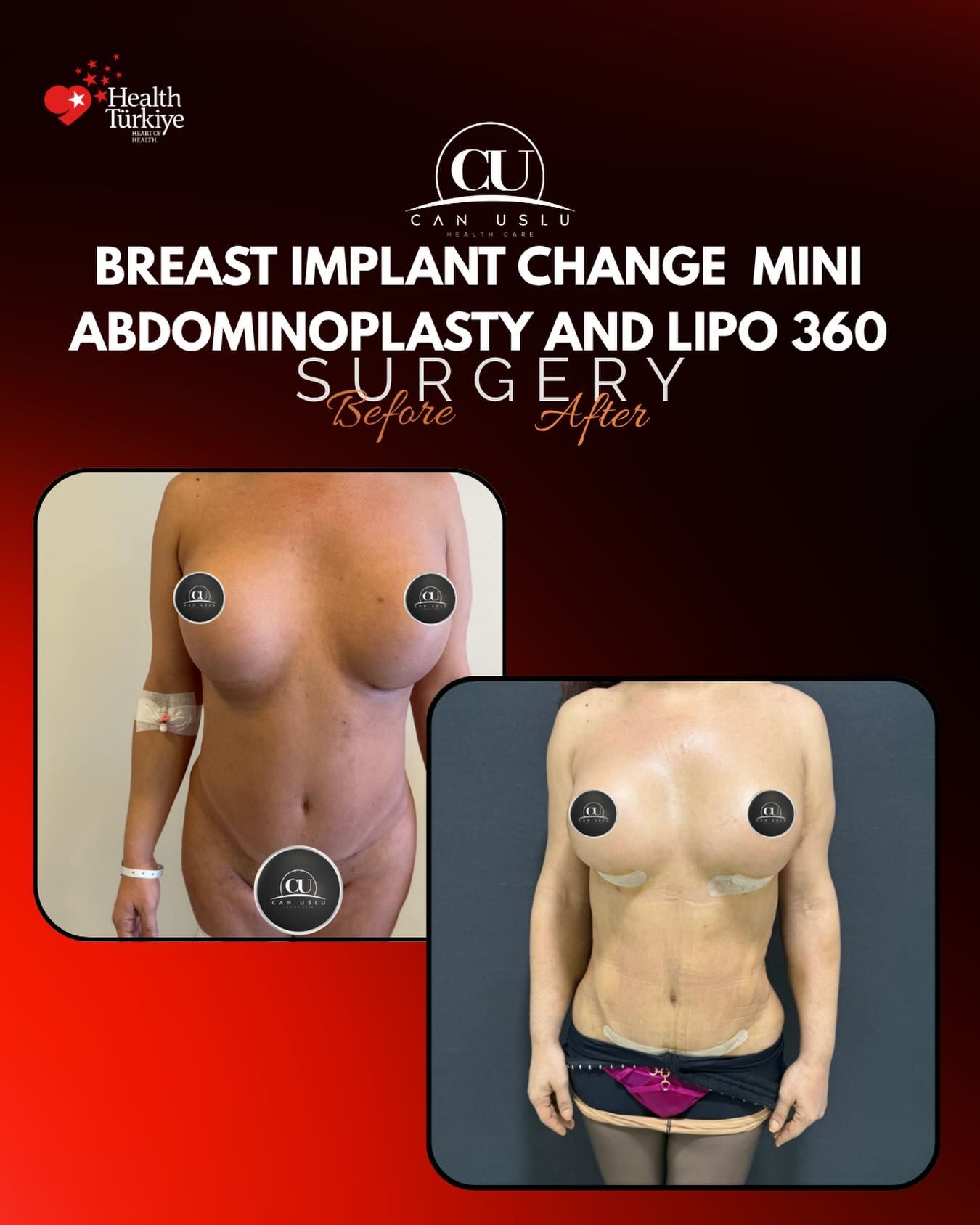 Liposuction before/after