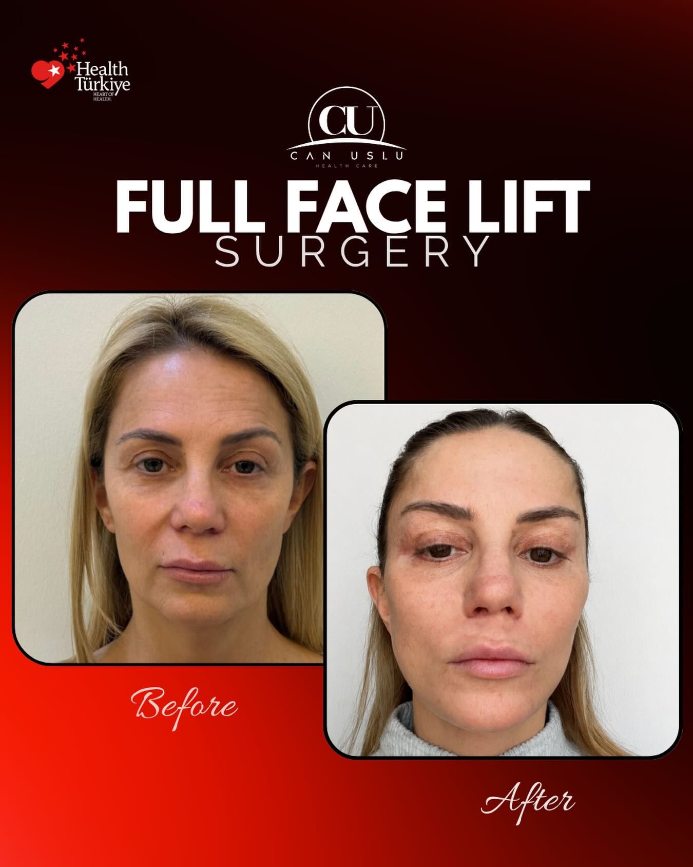 Deep Plane Facelift before/after