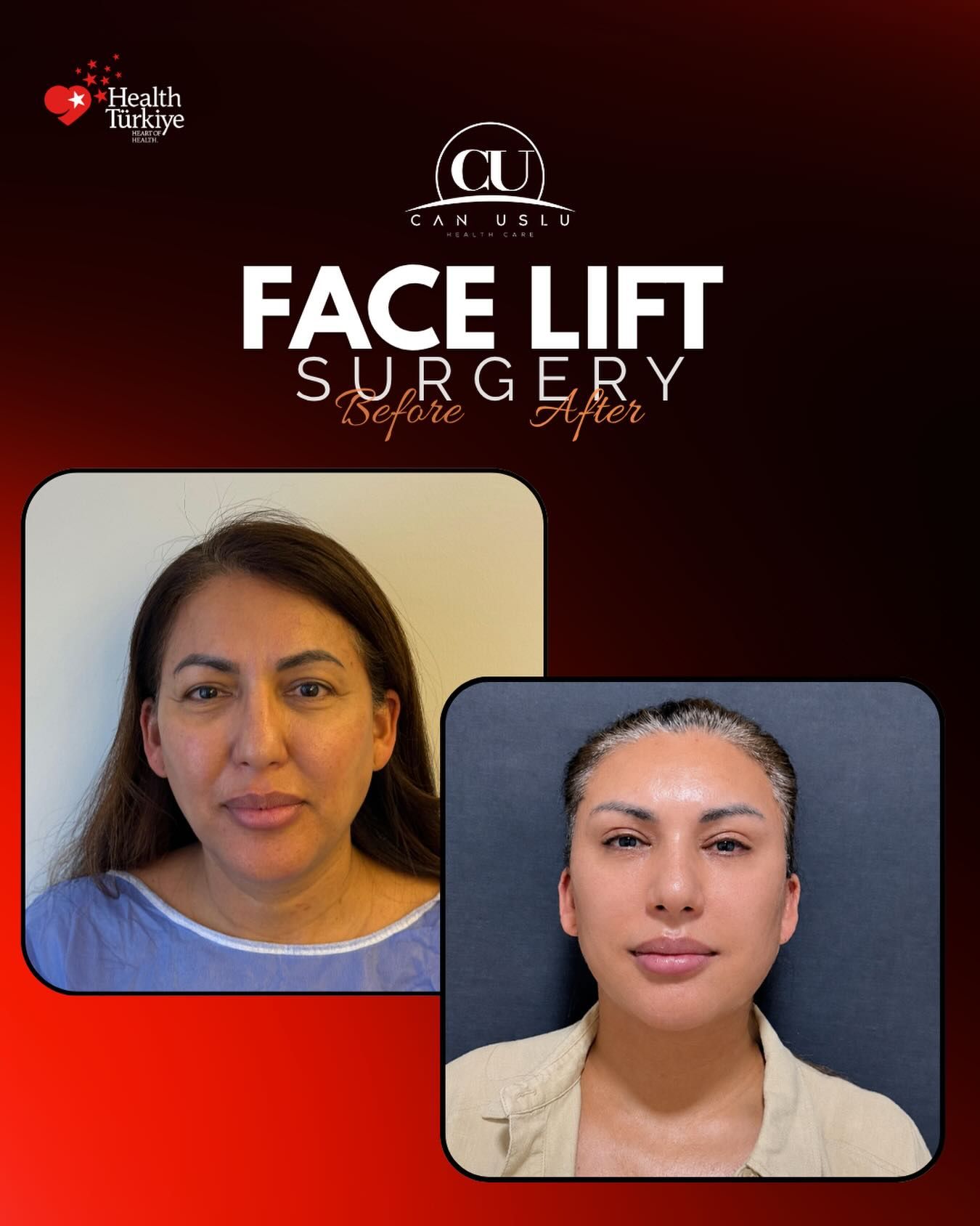 Deep Plane Facelift before/after