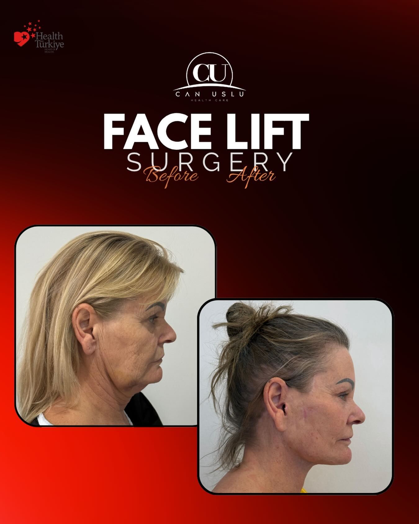 Deep Plane Facelift before/after