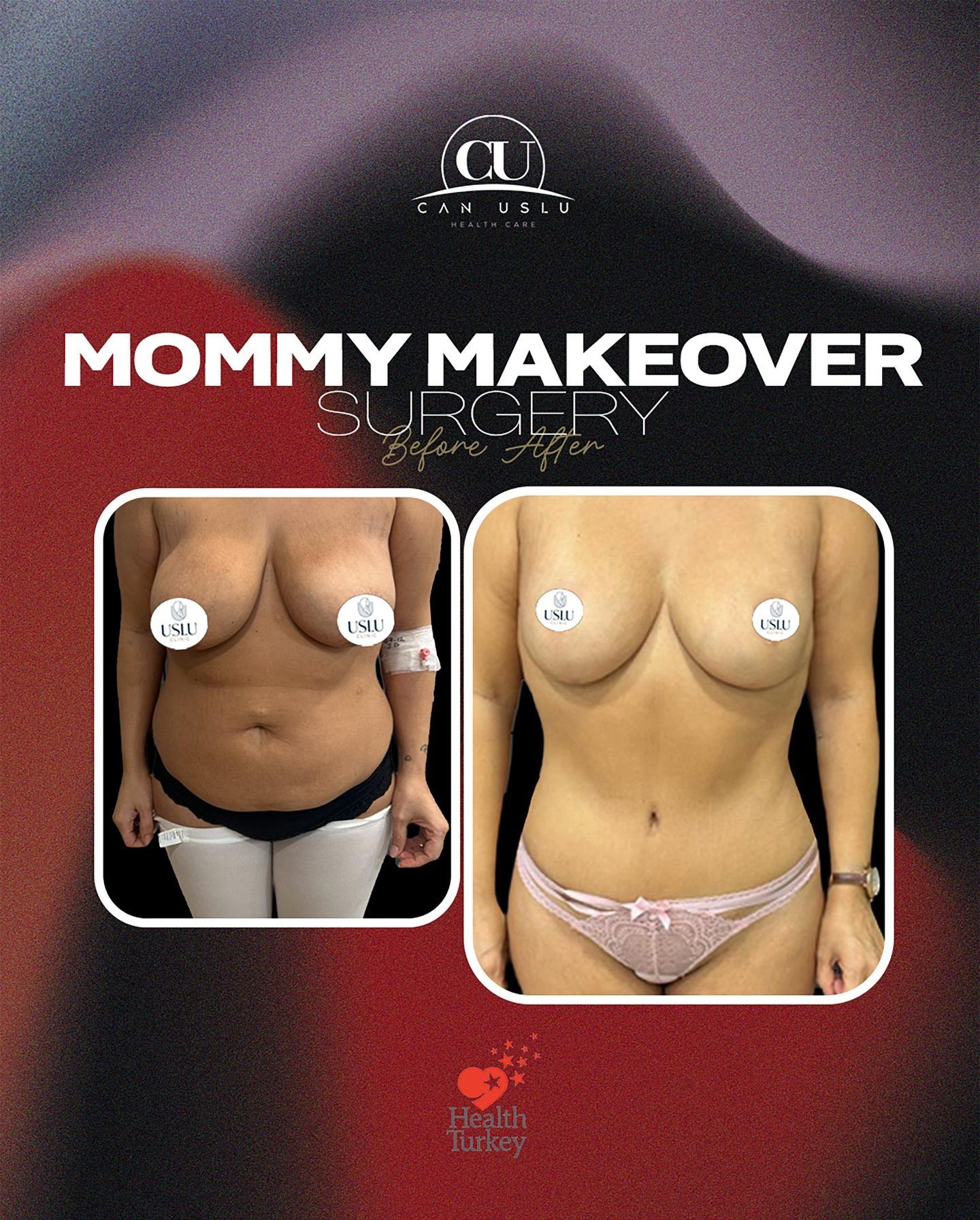 Mommy Makeover before/after