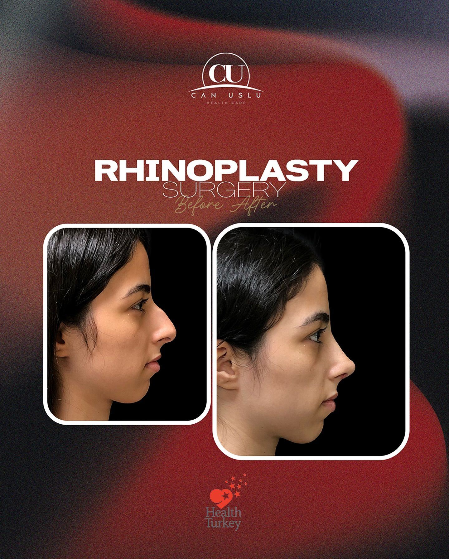 Rhinoplasty before/after